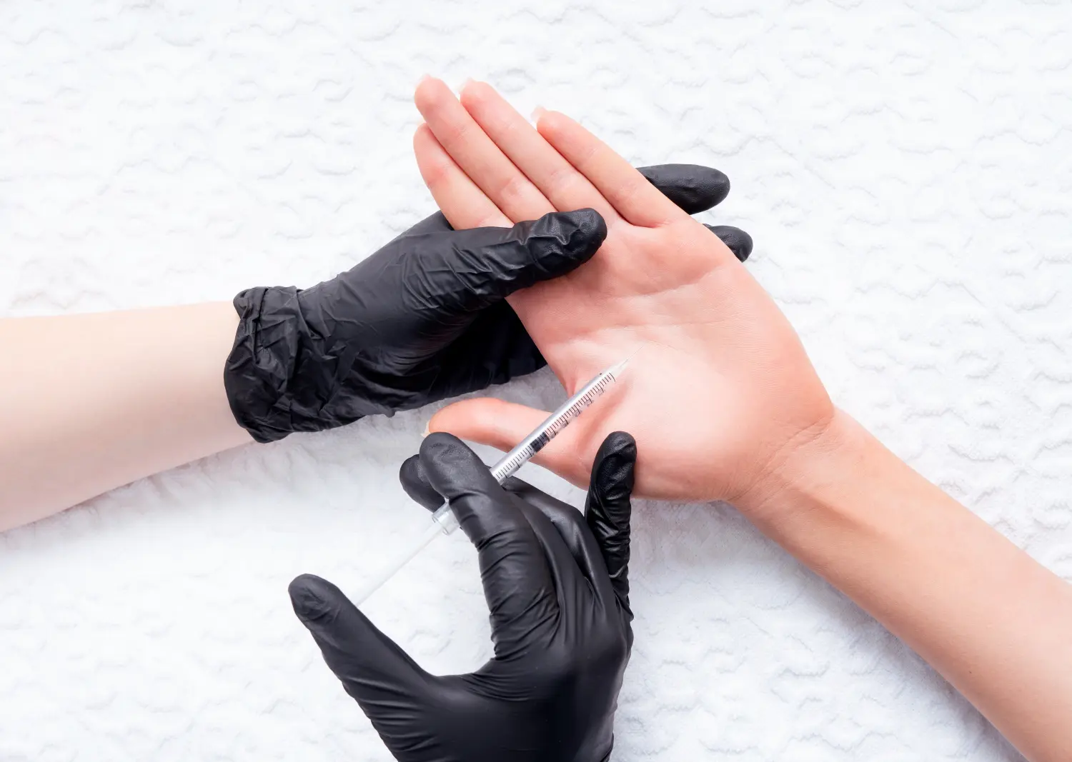 Behandlung von Palm-Hyperhidrose. Injektion eines Botulinumtoxin-haltigen Präparats in die Handfläche zur Behandlung von Schwitzen.