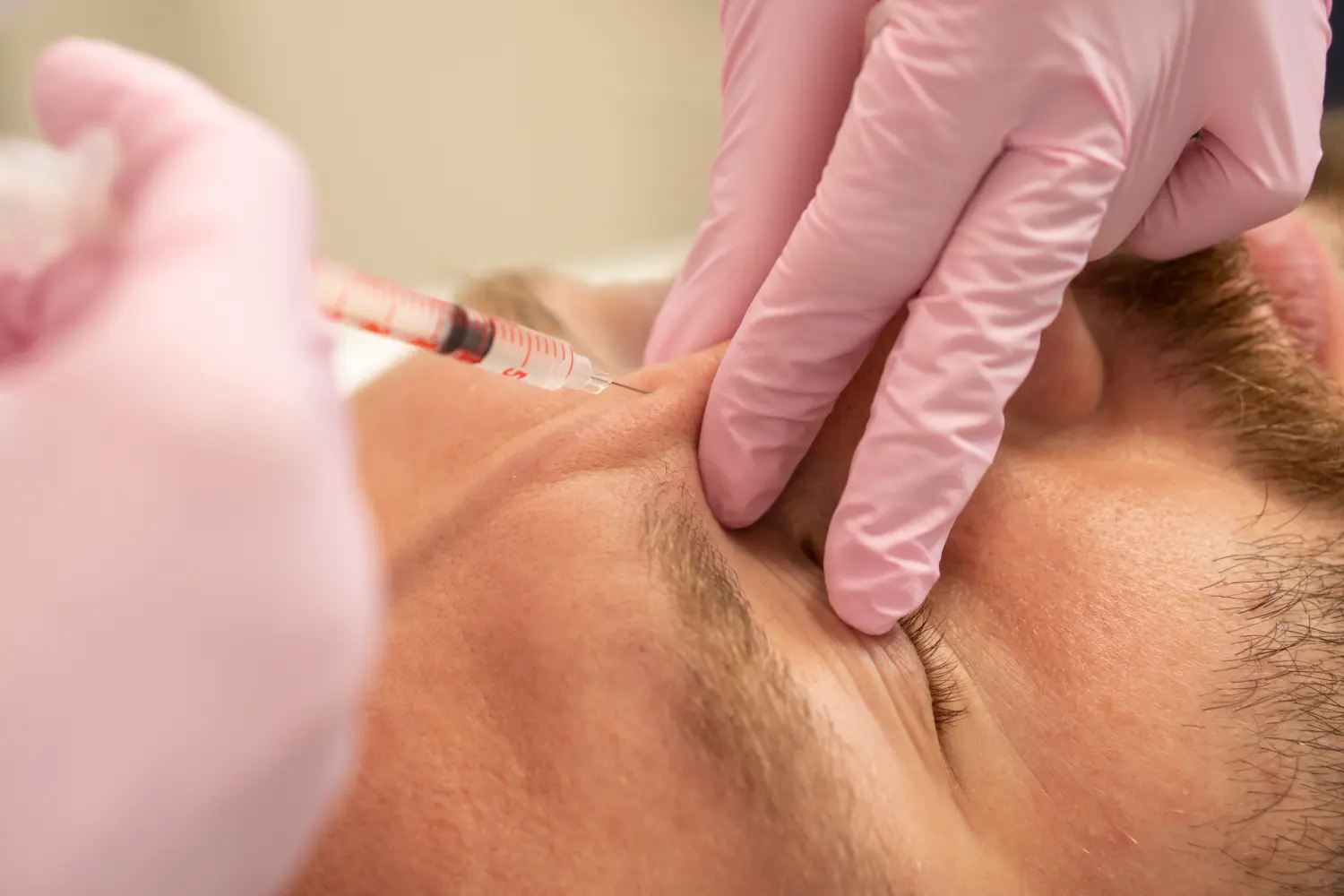 Aus nächster Nähe führt die Kosmetikerin einem Mann das Verfahren der Schönheitsinjektion von Botulinumtoxin in die Falten der Stirn und des Nasenrückens zur Verjüngung durch